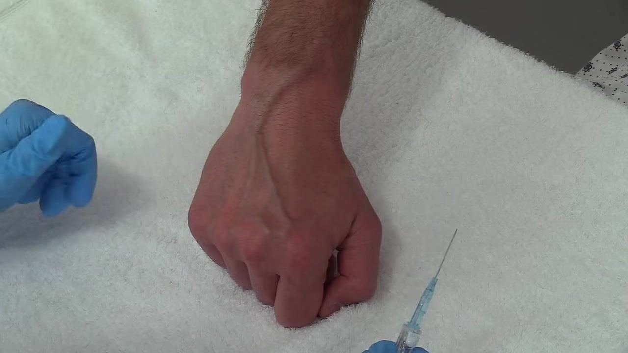Advancing the IV catheter into the vein while maintaining stabilization and insertion technique