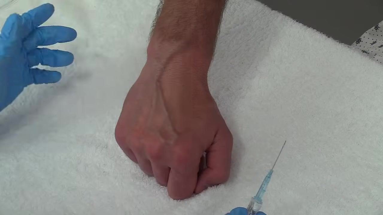 Inserting the IV catheter at a 20-degree angle into the hand vein
