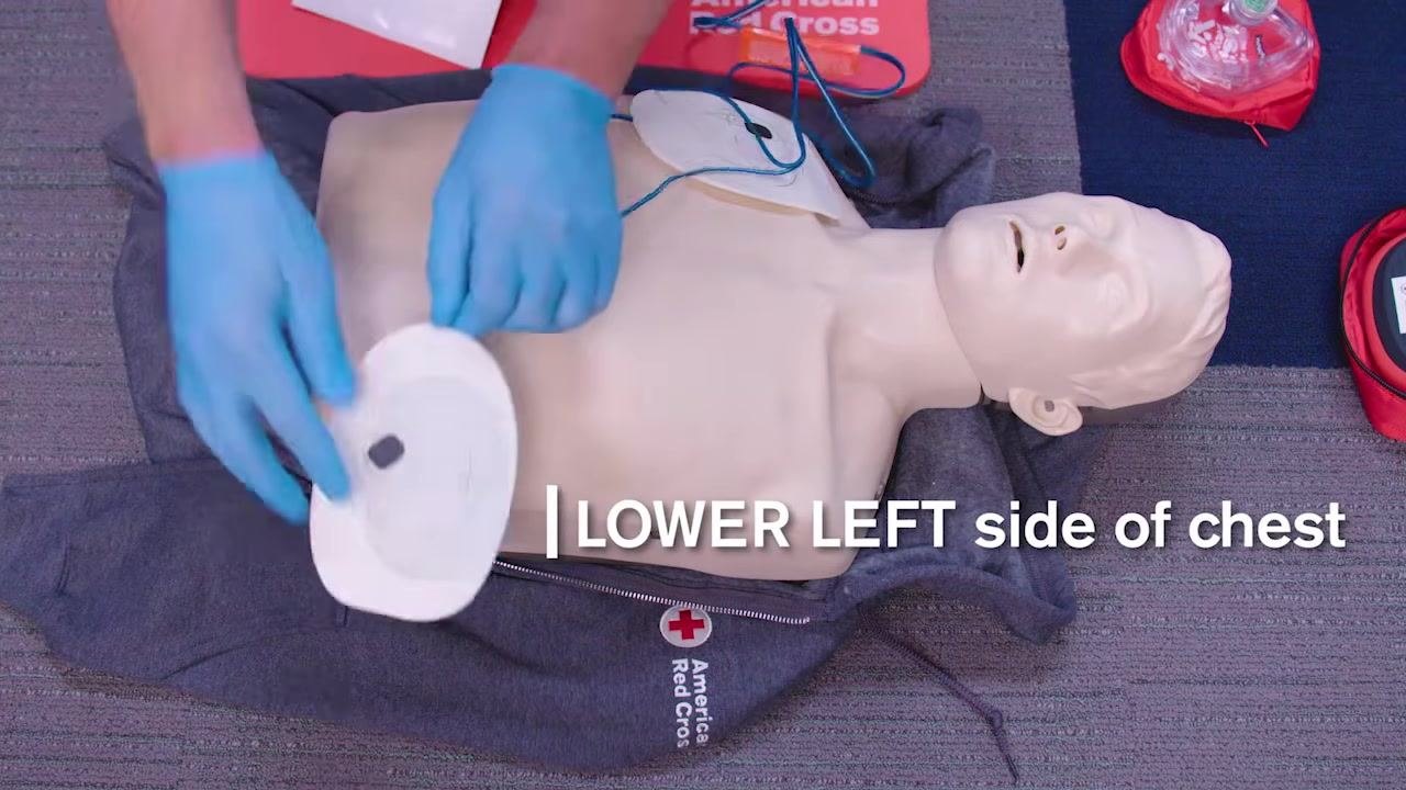 AED pads with an integrated feedback device and placement diagrams, text: "AED feedback device"